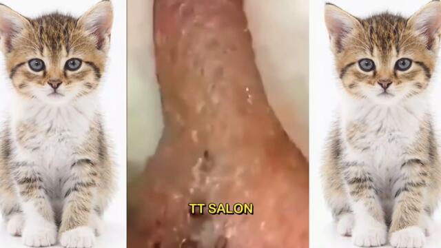 Cystic Acne Extraction This Week, Blackheads Removal, Blackhead Extraction #02