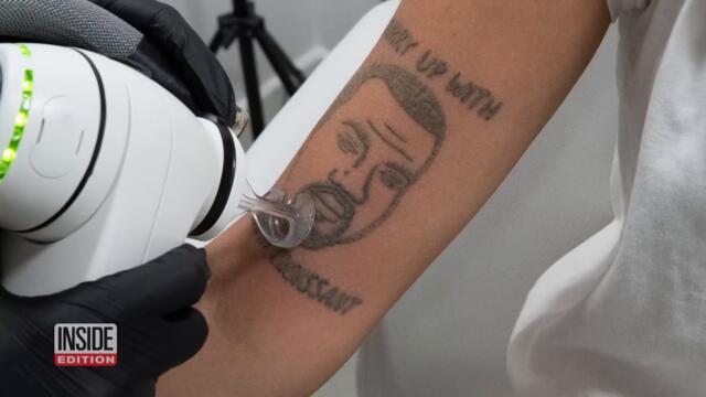 Kanye West Tattoos Removed for Free