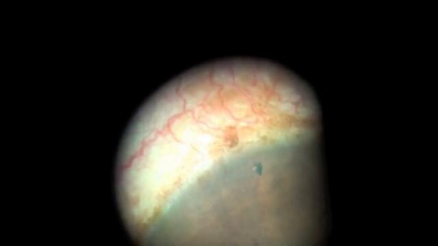 Лазерная иридэктомия ЛИЭ при глаукоме - живое видео операции