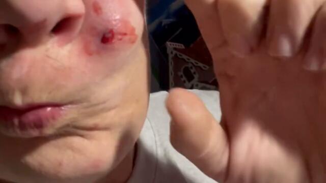 Sebaceous Cyst DIY Removal