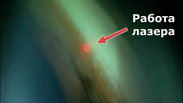 Селективная лазерная трабекулопластика СЛТ при глаукоме (SLT) - видео операции со стороны врачча