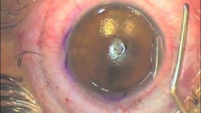 LASIK (ЛАСИК) - живое видео операции лазерной коррекции зрения в Prime Clinic (Москва)