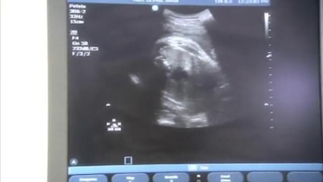 Лазерно разбиване на камъни в бъбреците - Vbox7[via torchbrowser.com]