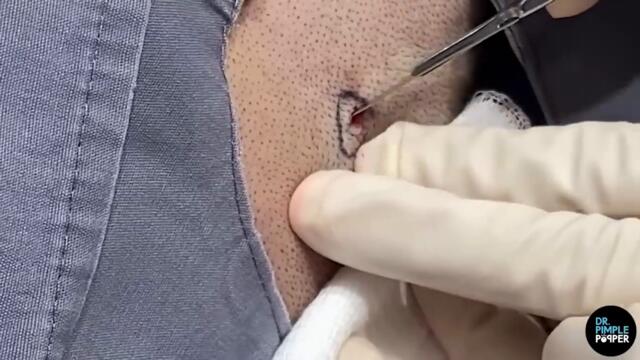 Splatter on the Wall Pilar Cysts