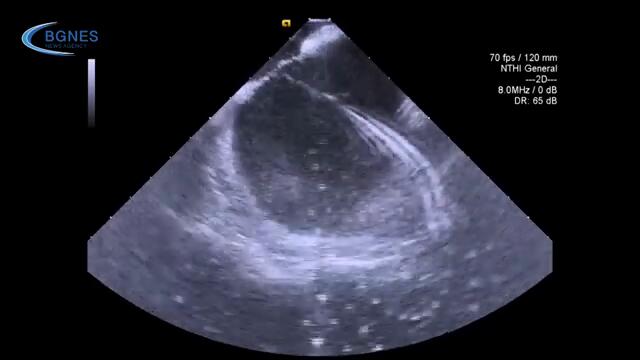 За първи път в България в УМБАЛ „Св. Анна“ бе направена Kриоаблация на белодробни вени без облъчване